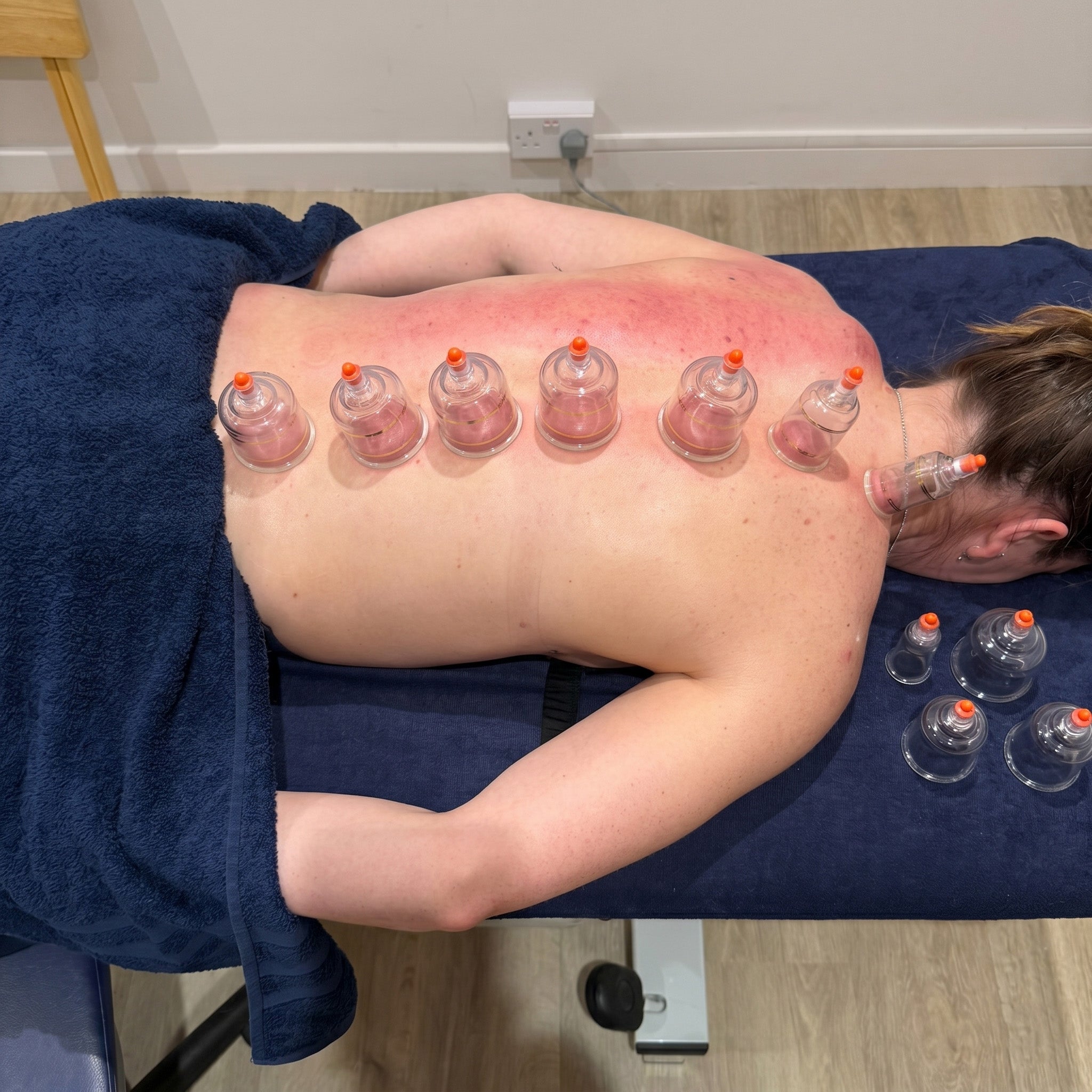 Dry Cupping Therapy